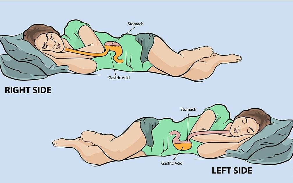 Na kterém boku spát při refluxu?