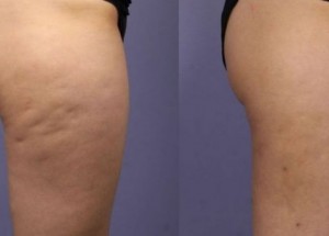 Smíchala tři suroviny a navždy zatočila s celulitidou. Konec zbytečného utrácení!