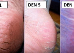 Jak si doma ošetřit popraskané paty? Je to maximálně účinné. Sledujte, jak na to!