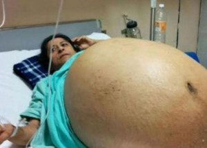 Tato žena vážila přes 130 kilogramů. Když potom doktoři zjistili, co je v ní, zůstali jak opaření...