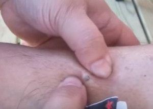 Měla 20 let na noze černou tečku. To, co přišlo, když jí na to zatlačila, je jen pro silné povahy...