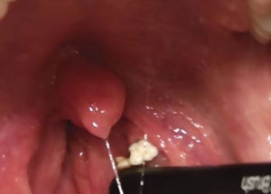 Toto má v krku každý čtvrtý člověk. Podívejte, jak se toho nadobro zbavit!