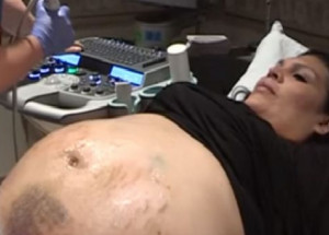 Těhotná žena měla celé břicho pokryto modřinami. Skutečný šok ale přišel, až když uviděli ultrazvuk!