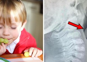 Matka sdílela rentgenový snímek svého syna: Pro děti je nebezpečná i kulička hroznového vína, upozorňuje