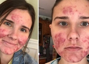 Dívka s cystickým akné se už neskrývá pod make-upem: Proč se tak rozhodla?