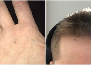 Nechtěné školní tetování: Máte i po letech na těle tečku od tužky či propisky?