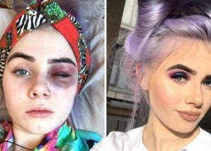 Modřiny a napuchlý obličej: Tuto dívku nikdo nezbil, trpí těžkou alergickou reakcí