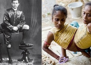 Lidé, kteří se narodili s částmi těla navíc. Objevovali se v minulosti a bohužel i dnes