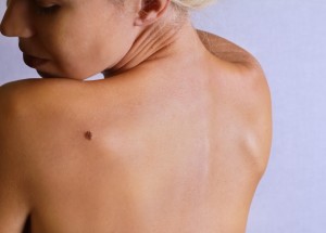 Podezřelá znaménka rozhodně nepodceňujte: Jak rozeznáte neškodné znaménko od rakovinového melanomu?