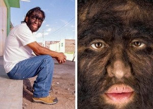 Poznejte nejpodivnější nemoci světa: Syndrom vlkodlaka, progérie i kamenná tvář