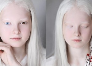 Čečenská dívka Amina Ependieva má dvě vzácné genetické vady. Díky albinismu a odlišné barvě očí však vypadá jako éterická víla