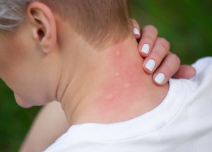 Není štípnutí jako štípnutí: Naučte se mezi sebou rozlišit hmyzí štípance, ale i bodnutí a kousnutí