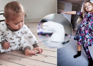 Švédská holčička s fibrózní hemimélií přišla o nohu v batolecím věku. Amputace jí však obrátila život k lepšímu