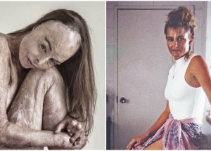 Bývalá australská miss Carol Mayer utrpěla popáleniny na 85 procentech těla. Po 20 letech nafotila sérii fotografií