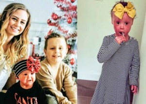 Čtyřletá Harper Foy se narodila s harlekýnovou ichtyózou. V rámci osvěty svého onemocnění se stala dětskou modelkou