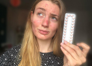 Antikoncepční pilulky vyvolaly u Miny Stein těžké akné. Dívka má nenávratně zničenou tvář