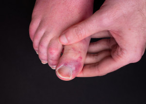 Covidové prsty přetrvávají až pět měsíců po překonání infekce. Tento projev zvaný “long covid” může dle vědců značit zánět v těle