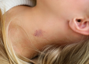 Jak se zbavit cucfleku? Následující triky urychlí jeho hojení