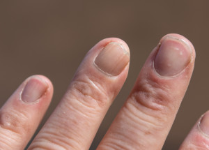 Covidové nehty: Nový příznak koronaviru, ke kterému dochází až po prodělání nemoci