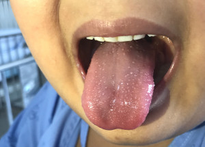 Covidový jazyk v podobě vředů na jazyku: Jeden z příznaků covidu-19