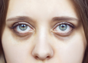 Kruhy pod očima neznamenají jenom nedostatek spánku. Známe překvapivé důvody jejich vzniku