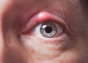 5 účinných metod, jak se rychle a bezbolestně zbavit ječného zrna