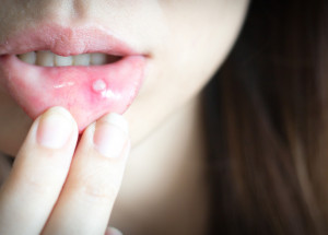 Jak se účinně zbavit aftů? Pomůže vám med i hroznové víno