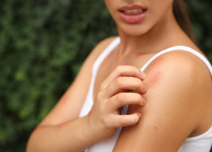 Jak se efektivně zbavit svědění po štípnutí od komára? Těchto 5 triků funguje perfektně