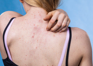 Trápí vás akné na zádech nebo v dekoltu? Může za to častá chyba při sprchování