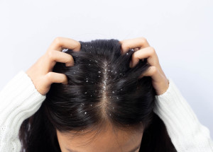 Zbavte se navždy lupů pomocí jednoduchého triku. Tohle vám zaručeně pomůže