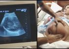 Angličanka Vanessa Fisher nechtěla rodit císařským řezem. Lékař pomocí techniky ECV obrátil dítě do správné polohy