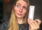 Antikoncepční pilulky vyvolaly u Miny Stein těžké akné. Dívka má nenávratně zničenou tvář