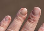 Covidové nehty: Nový příznak koronaviru, ke kterému dochází až po prodělání nemoci