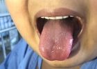 Covidový jazyk v podobě vředů na jazyku: Jeden z příznaků covidu-19