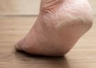 Prasklá pata do krve je častý letní problém. Jak vyléčit prasklinu na patě, aby se zacelila a nebolela?