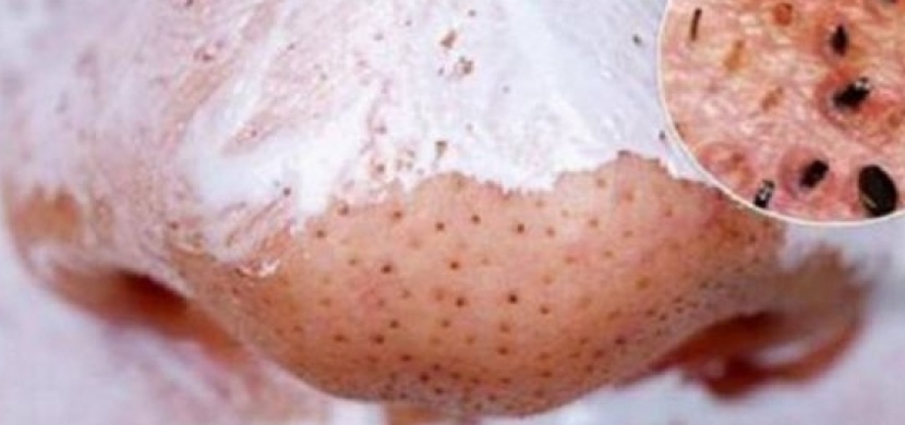 Stačí smíchat dvě ingredience a během malé chvíle se zbavíte černých teček!
