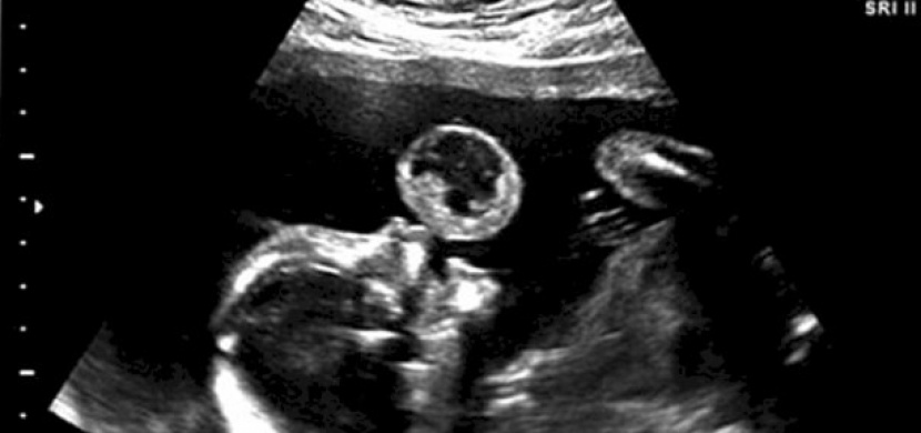 Vypadalo to na ultrazvuku jako dítě s bublinou. Po chvíli ale lékař zjistil děsivou pravdu...