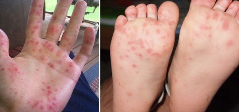 Nejnakažlivější nemoc na světě, která postihuje zejména malé děti - Slintavka a kulhavka