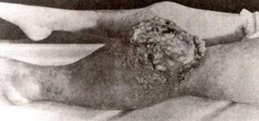Tato žena zemřela podle lékařů na syfilis. Když ale pak otevřeli rakev, zjistili děsivou pravdu!
