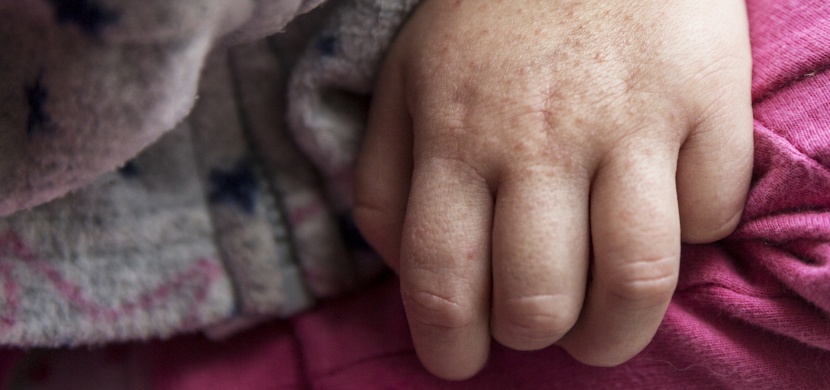 Vážné infekční onemocnění se vrací. Na tyto příznaky u svých dětí dávejte pozor