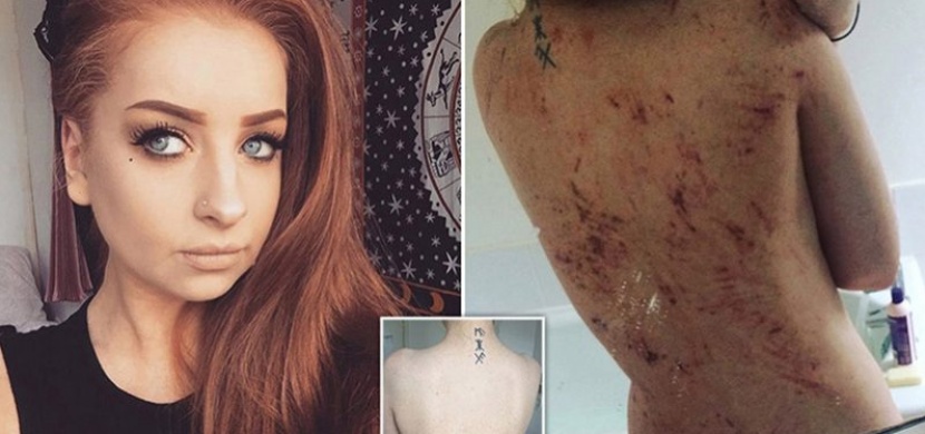 Dívka dlouhé roky trpěla chronickým ekzémem po celém těle. Řešení našla ve veganství
