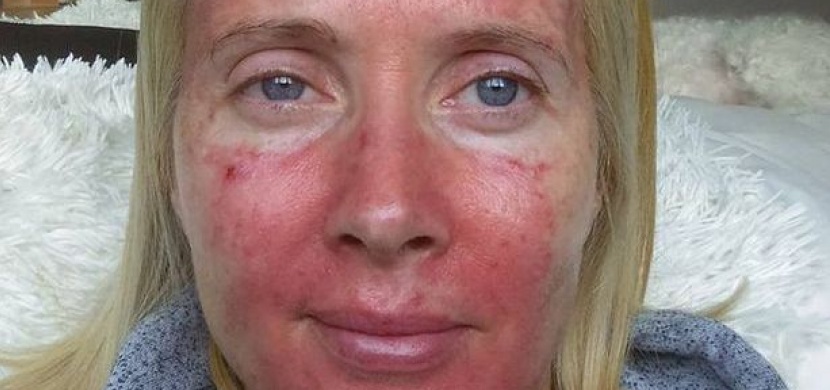 Žena si myslela, že má lupénku: Po sedmi letech zjistila, že trpí mnohem zákeřnější chorobou
