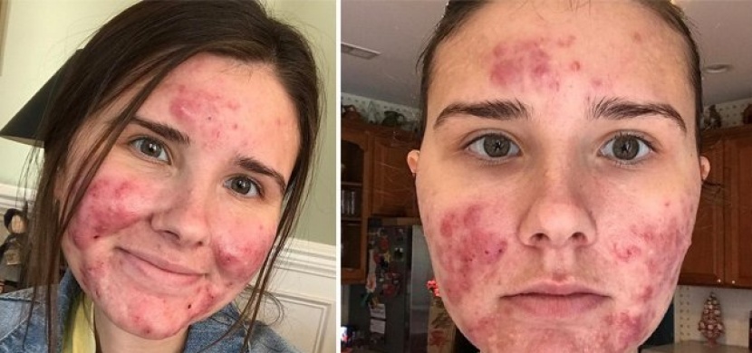 Dívka s cystickým akné se už neskrývá pod make-upem: Proč se tak rozhodla?