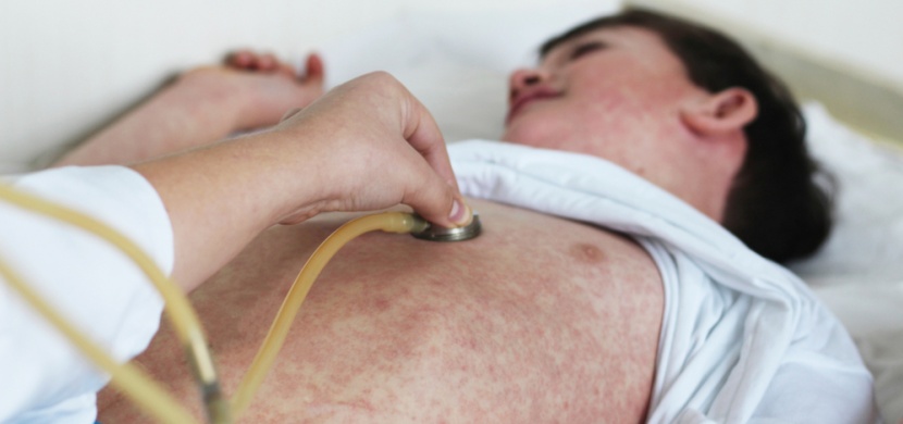 Obávané spalničky mají typické příznaky: Jak probíhá jejich léčba, když očkování selhalo?