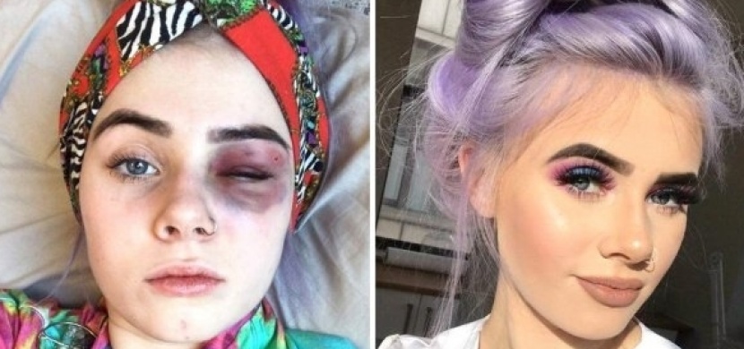 Modřiny a napuchlý obličej: Tuto dívku nikdo nezbil, trpí těžkou alergickou reakcí