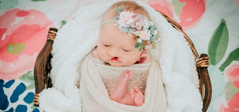 Holčička Christian Grace se narodila s rozštěpem horního rtu a patra: Nyní je miláčkem Instagramu