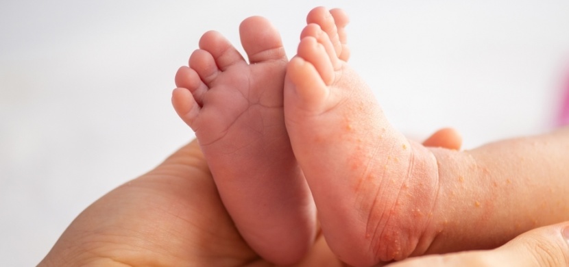Šestá nemoc neboli roseola infantum: Běžné dětské onemocnění, které je rizikem pro těhotné ženy