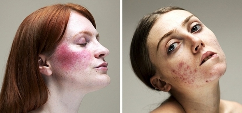 Fotografka Sophie Harris Taylor ukazuje tváře skutečných žen: Bez make-upu i s jejich kožními problémy