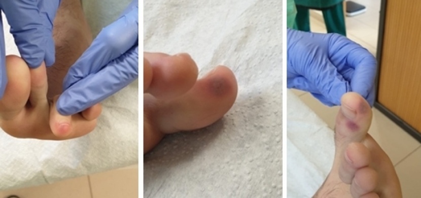 Kožní léze na nohou připomínající neštovice: Nový příznak koronaviru, který je častý u dětí a teenagerů