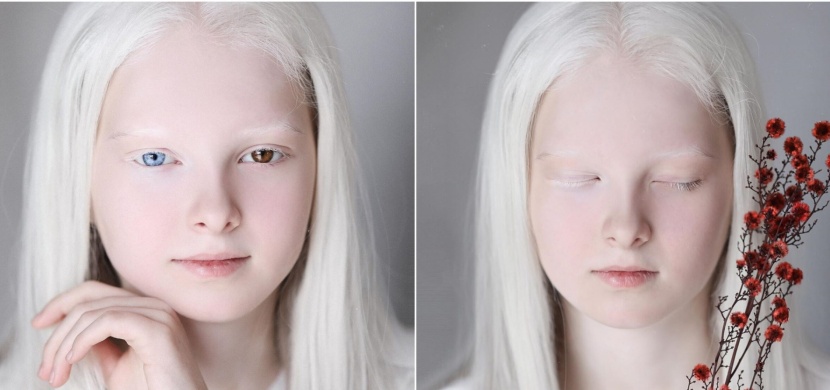 Čečenská dívka Amina Ependieva má dvě vzácné genetické vady. Díky albinismu a odlišné barvě očí však vypadá jako éterická víla